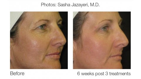 Sublative Rejuvenation Skin Treatment