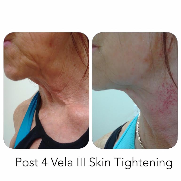 Post 4 Vela III Skin Tightening