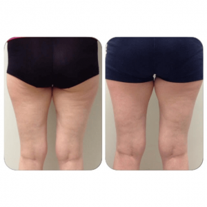 can-you-get-rid-of-cellulite-once-you