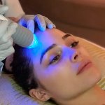 microneedling