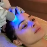 microneedling