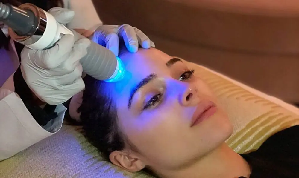 microneedling