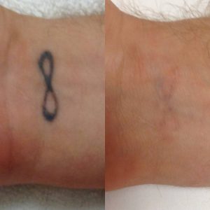 A Bit About Laser Tattoo Removal