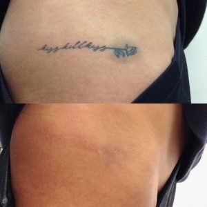 Considering PicoWay Laser Tattoo Removal at BeautySmart Medical Spa in Boca Raton, Florida?