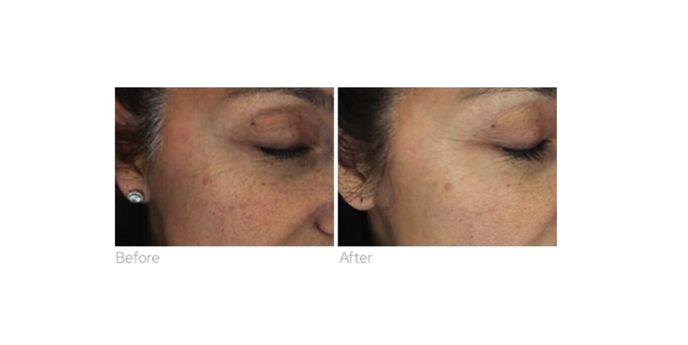 Before and after exosome treatment skin rejuvenation results