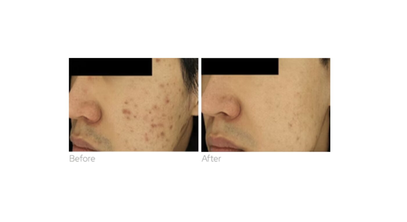 Before and after exosome therapy improvement in skin appearance